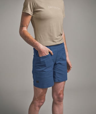 Eine Frau in einem beigen T-Shirt und blauen Shorts mit Vitiligo. Eine Frau in einem beigen T-Shirt und blauen Shorts mit Vitiligo.